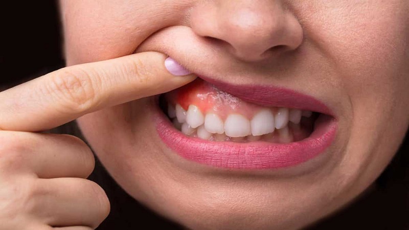 کاهش ورم لثه و صورت | بهترین دندانپزشک اصفهان