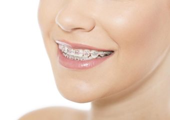 بررسی انواع ارتودنسی ثابت | بهترین ایمپلنت اصفهان