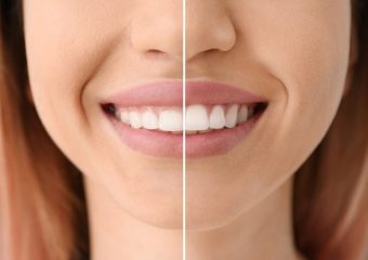 جِنجیوکتومی، لیفت یا کانتورینگ لثه | بهترین ایمپلنت اصفهان