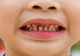 شکستگی دندان های جلو | بهترین دندانپزشک اصفهان