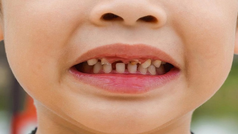 شکستگی دندان های جلو | بهترین دندانپزشک اصفهان