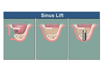 عمل لیفت سینوس باز و بسته پیش از کاشت ایمپلنت دندان | بهترین ایمپلنت اصفهان