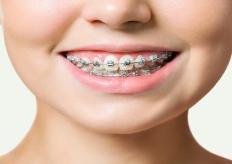 قالب گیری برای ارتودنسی | بهترین دندانپزشک اصفهان