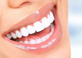 لمینت دندان | بهترین دندانپزشک اصفهان