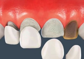 مراحل انجام لمینت دندان | بهترین دندانپزشک زیبایی اصفهان