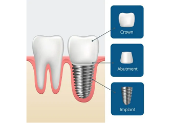 مراحل عمل کاشت ایمپلنت دندان | بهترین دندانپزشک زیبایی اصفهان
