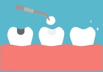 مقایسه پر کردن دندان با کامپوزیت و سرامیک | بهترین ایمپلنت اصفهان