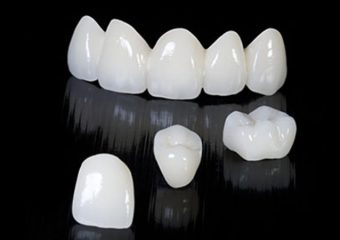 نکات مراقبتی از روکش دندان | بهترین دندانپزشک زیبایی اصفهان