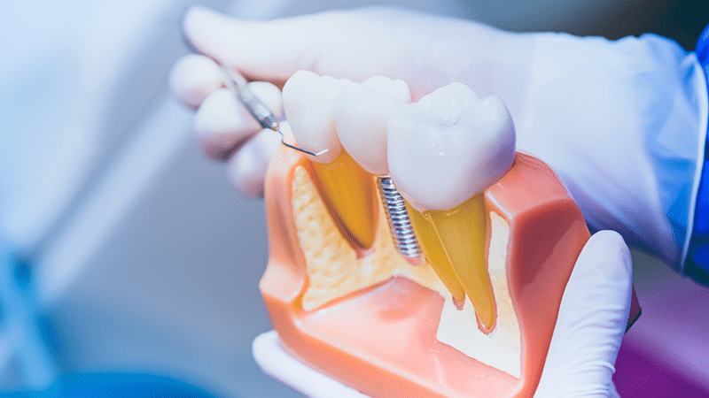 نکاتی پیرامون کاشت ایمپلنت دندان | بهترین دندانپزشک زیبایی اصفهان