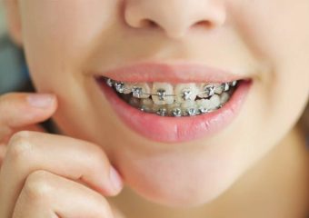 پلاک متحرک ارتودنسی | بهترین دندانپزشک اصفهان