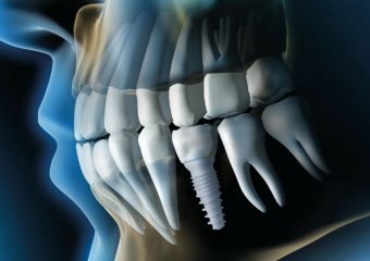 ایمپلنت دندان 6 | بهترین ایمپلنت اصفهان