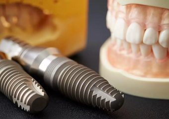 ایمپلنت برای لثه تحلیل رفته | بهترین دندانپزشک زیبایی اصفهان