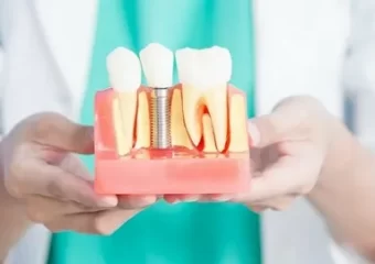 ایمپلنت به روش پانچ | بهترین ایمپلنت اصفهان