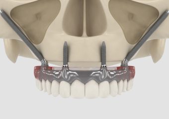ایمپلنت دندان زایگما | بهترین ایمپلنت اصفهان