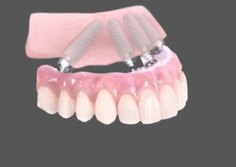 ایمپلنت زاویه دار | بهترین ایمپلنت اصفهان