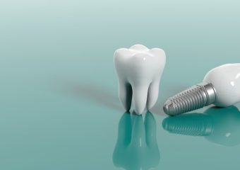 ایمپلنت پیچ شونده | بهترین ایمپلنت اصفهان