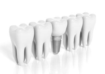 ایمپلنت ژاپنی | بهترین ایمپلنت اصفهان