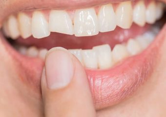 دلایل شکستن روکش لمینت دندان | بهترین دندانپزشک اصفهان