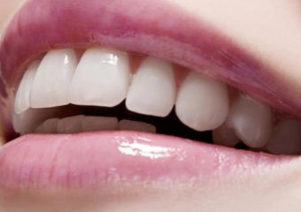 دوام لمینت دندان | بهترین دندانپزشک اصفهان