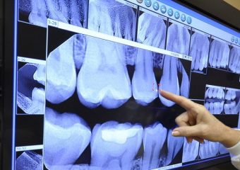 عکس cbct برای ایمپلنت | بهترین ایمپلنت اصفهان