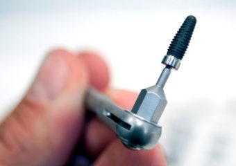 فیکسچر ایمپلنت دندان | بهترین دندانپزشک اصفهان