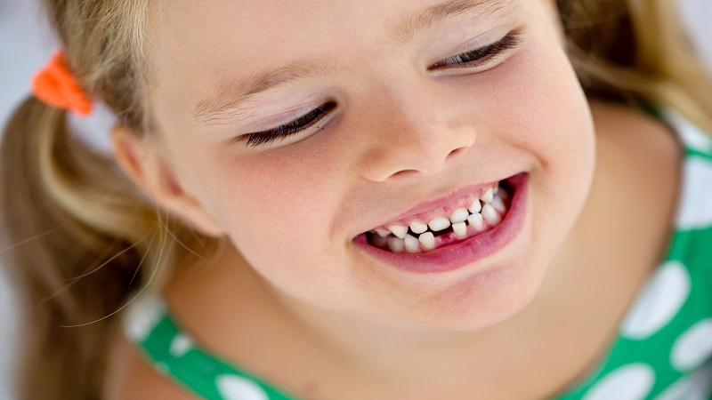 چند روش برای افتادن دندان شیری | بهترین ایمپلنت اصفهان
