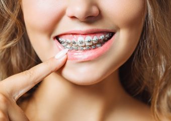 بهترین ایمپلنت اصفهان | بهترین دندانپزشک زیبایی اصفهان | دکتر ندا مکانیک | بهترین زمان برای انجام ارتودنسی | بهترین دندانپزشک اصفهان