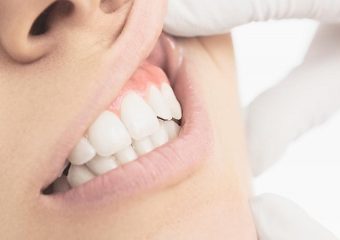 دلایل سیاه شدن لثه ها | بهترین دندانپزشک زیبایی اصفهان