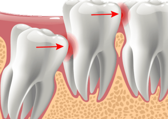 مراقبت بعد از جراحی | بهترین ایمپلنت اصفهان