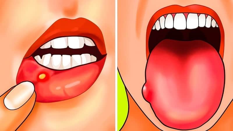 پیشگیری و درمان آفت دهان | بهترین دندانپزشک زیبایی اصفهان