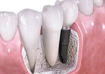 کاشت دندان 7 | بهترین ایمپلنت اصفهان