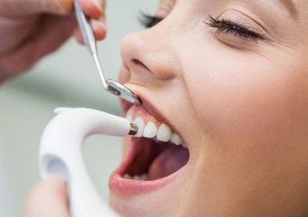 آشنایی با انواع جرم گیری دندان | بهترین ایمپلنت اصفهان