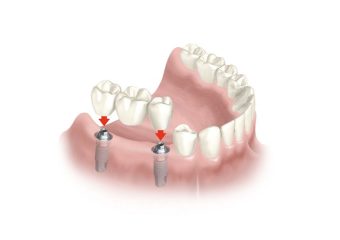 اهمیت کاشت ایمپلنت دندان آسیاب | بهترین دندانپزشک زیبایی اصفهان