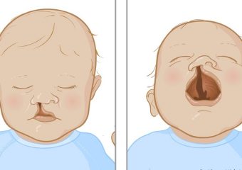 تشخیص و درمان شکاف کام و لب | بهترین دندانپزشک زیبایی اصفهان