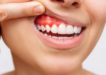 بهترین ایمپلنت اصفهان | بهترین دندانپزشک زیبایی اصفهان | بهترین دندانپزشک اصفهان | بهترین دندانپزشک کودکان اصفهان | روش های درمان لثه تحلیل رفته