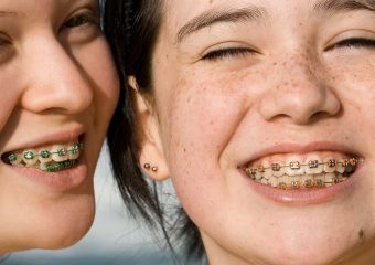 علل زردی دندان ها با وجود بریس | بهترین ایمپلنت اصفهان