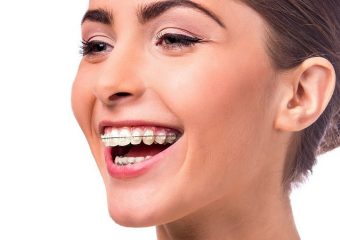 مراحل استفاده از موم ارتودنسی | بهترین دندانپزشک اصفهان