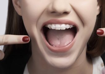 هدف از ارتودنسی در سنین مختلف | بهترین دندانپزشک اصفهان