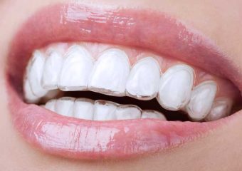 کاربردهای محافظ دندان | بهترین دندانپزشک زیبایی اصفهان