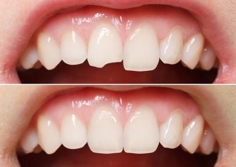 آشنایی با انواع باندینگ دندان | بهترین دندانپزشک زیبایی اصفهان