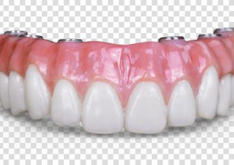 ایمپلنت تمام دندان ها | بهترین دندانپزشک اصفهان