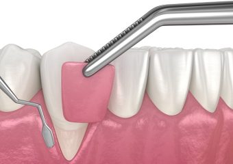 روش های پیوند لثه در جراحی لثه تحلیل رفته | بهترین دندانپزشک زیبایی اصفهان