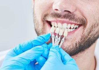 لنز دندانی | بهترین دندانپزشک اصفهان