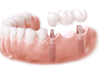 مزیت های کاشت ایمپلنت ظریف بجای دندان مصنوعی | بهترین ایمپلنت اصفهان