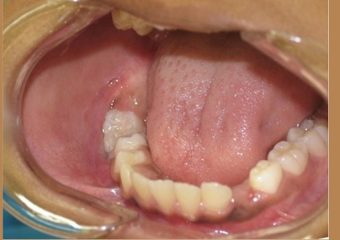 وستیبول دندان | بهترین دندانپزشک اصفهان