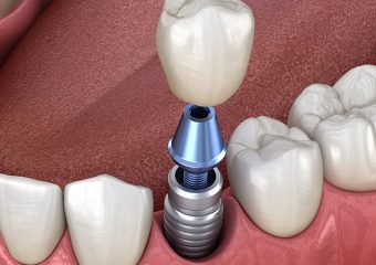 ایمپلنت ساب پروستئال | بهترین ایمپلنت اصفهان