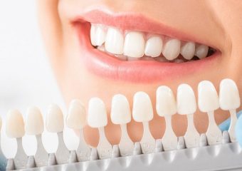 بهترین نوع لمینت دندان | بهترین دندانپزشک اصفهان