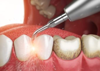 جرم گیری دندان | بهترین دندانپزشک زیبایی اصفهان