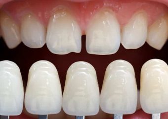 دلایل آسیب دیدن لمینت های دندانی | بهترین دندانپزشک زیبایی اصفهان