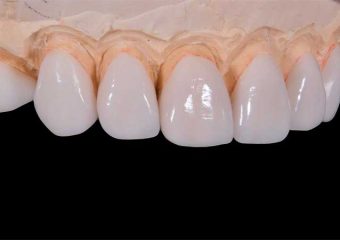 دلایل تعویض لمینت دندان | بهترین ایمپلنت اصفهان